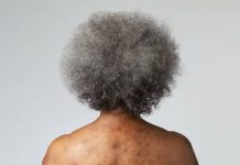 Grey hair may be sign body is fighting skin cancer -Study